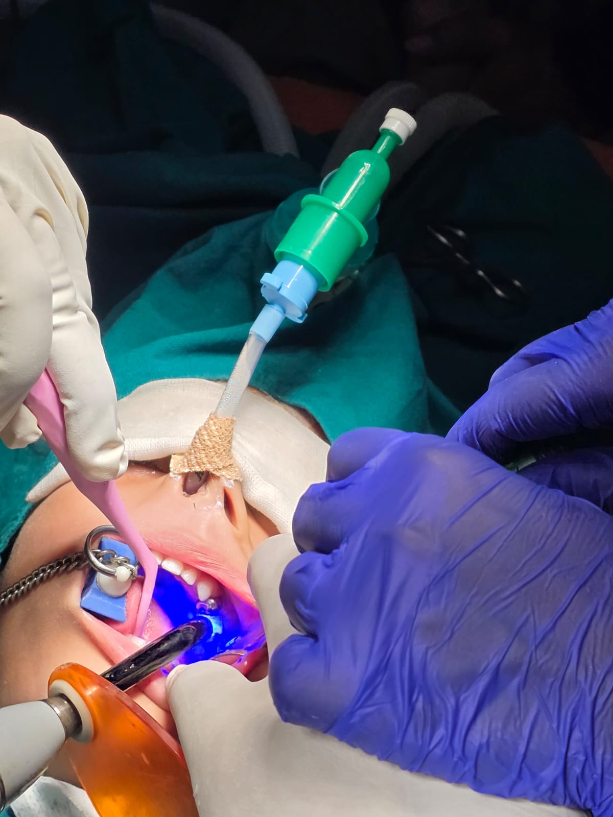 Pediatric dental treatment under general anaesthesia at children's hospital — Balaji's Best Dental Hyderabad